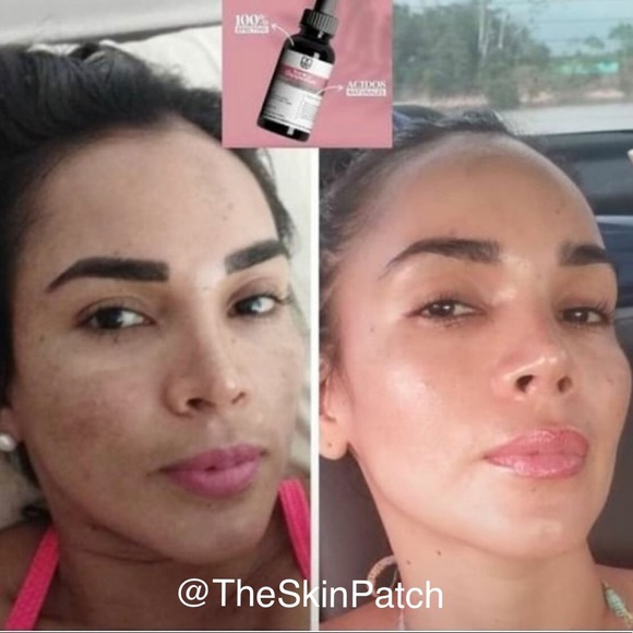 LB Tónico Despigmentante🇨🇴* Eliminador de manchas* Removes dark spots + … - Picture 8 of 15